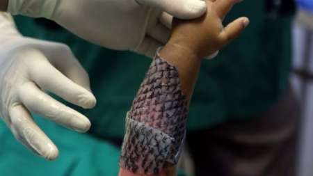 پوست ماهی تیلاپیا برای درمان سوختگی