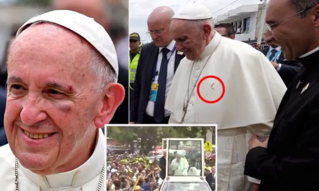 پاپ فرانسیس زخمی شد